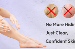 Bacne & Strawberry Legs: Causes, Prevention & Treatments That Work