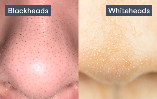 Blackheads vs. Whiteheads: What’s the Difference? - Himuggu