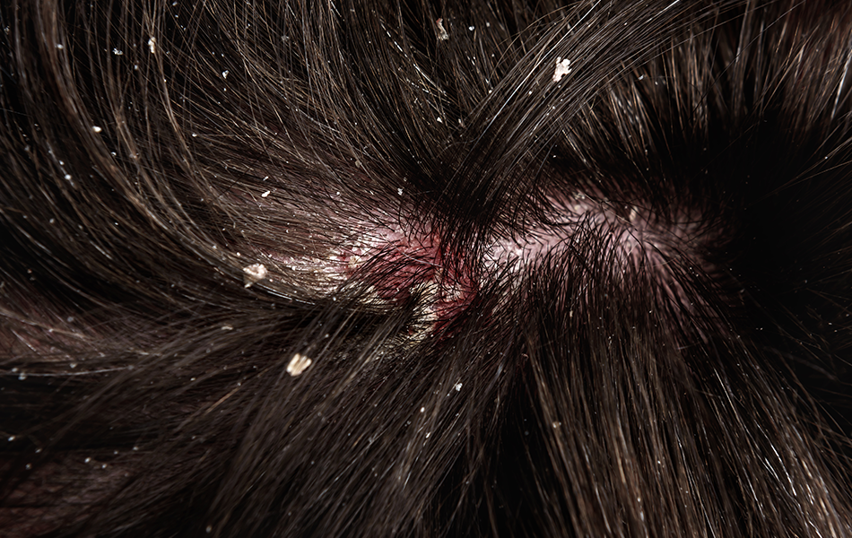 How to Get Rid of a Flaky Scalp? - Himuggu