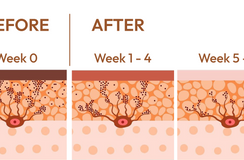 How Kojic Acid Cream for Pigmentation Works at the Cellular Level?