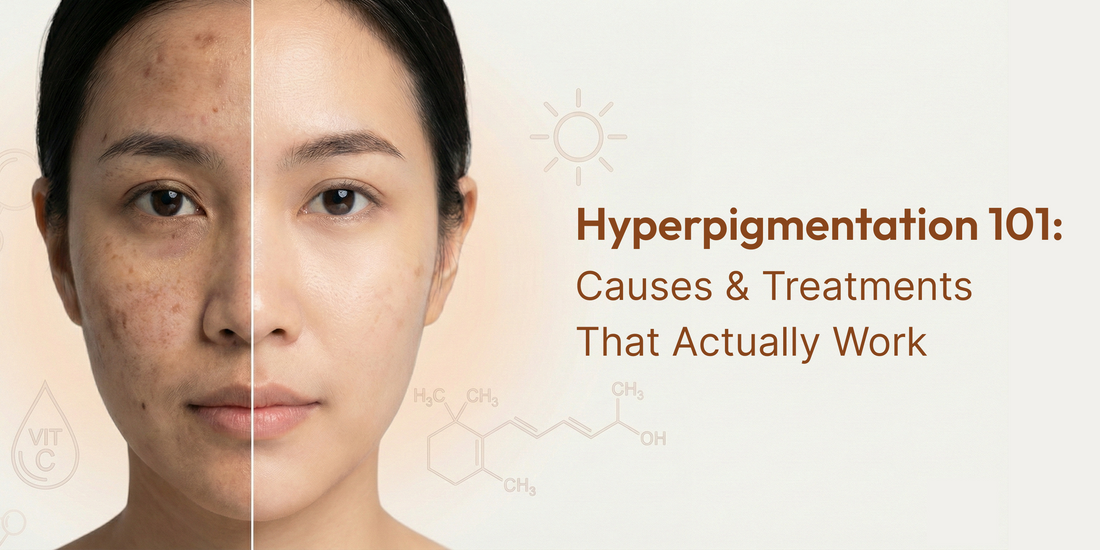 Hyperpigmentation 101: Causes & Treatments That Actually Work