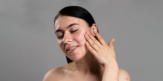 Tips To Take Care Of Acne Prone Skin