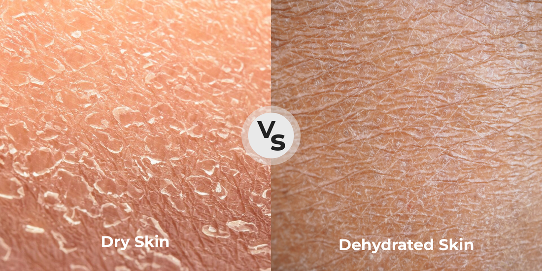 dehydrated skin