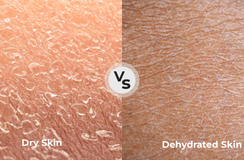 Dry vs. Dehydrated Skin: What’s the Difference?