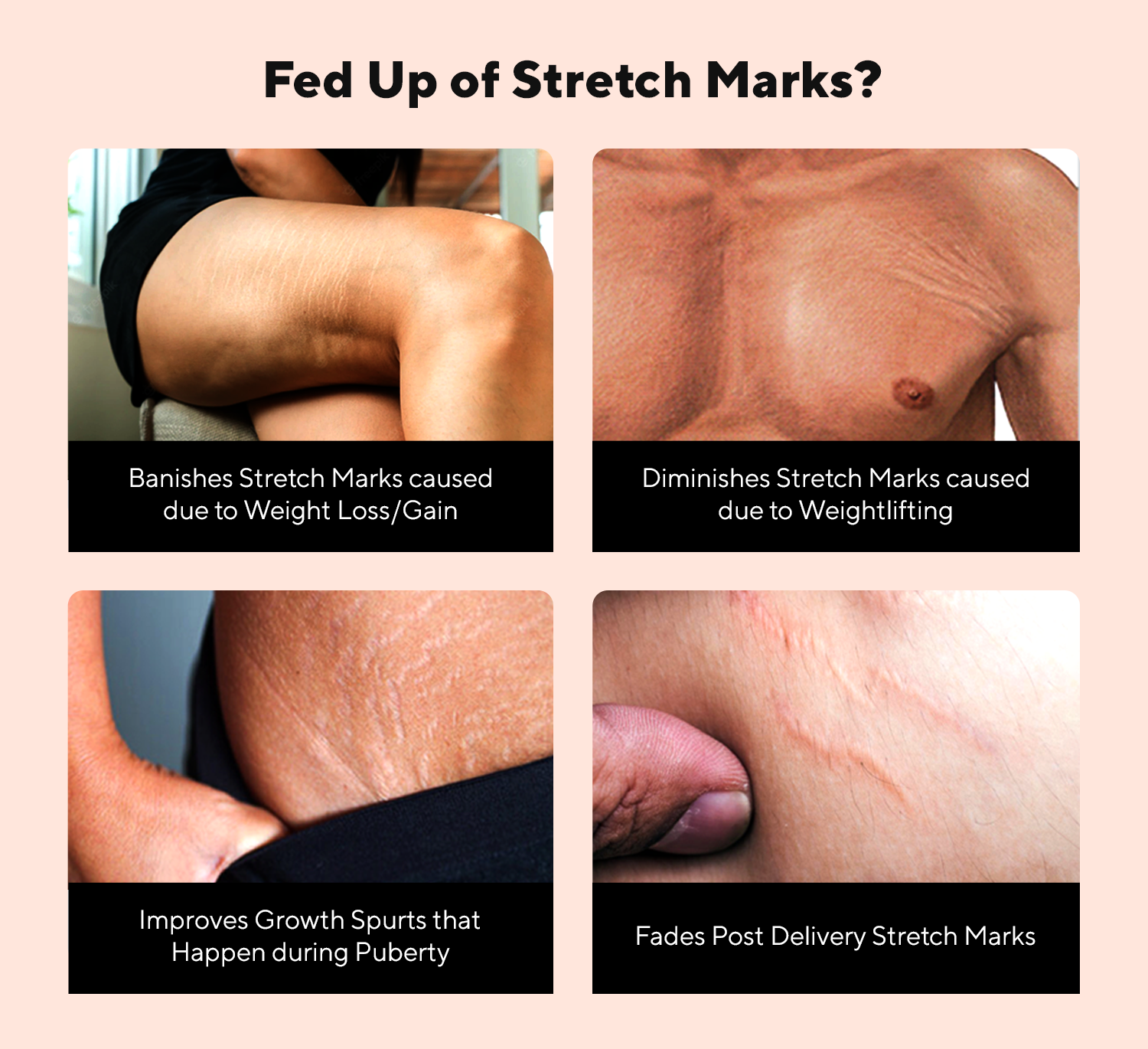 Stretch Mark Cream | Stretch Marks Removal Cream | 50gm - Muggu SkinCare